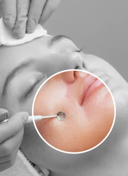 Rhinoplastik